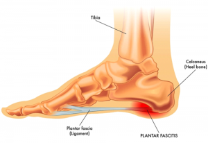 Plantar Fasciitis heel pain