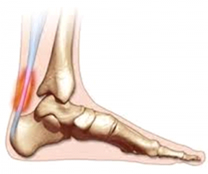 Achilles Tendinopathy / Tendinitis Treatments in Brisbane