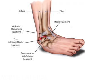 Acute Lateral Ankle Sprains ‘Inversion Sprain’