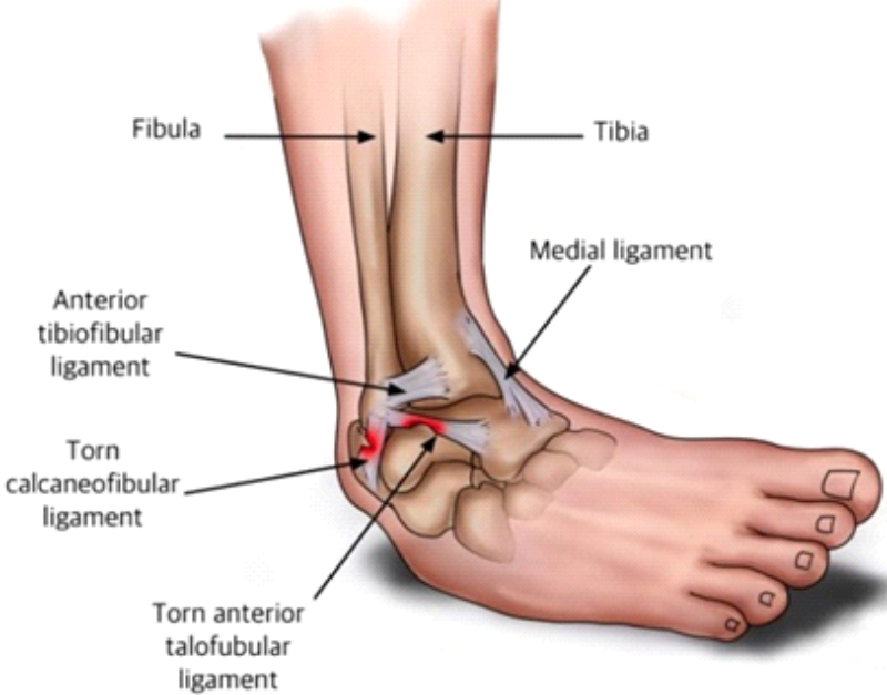 Acute Lateral Ankle Sprains ‘Inversion Sprain’