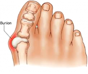 Hallux Abducto-Valgus Treatments