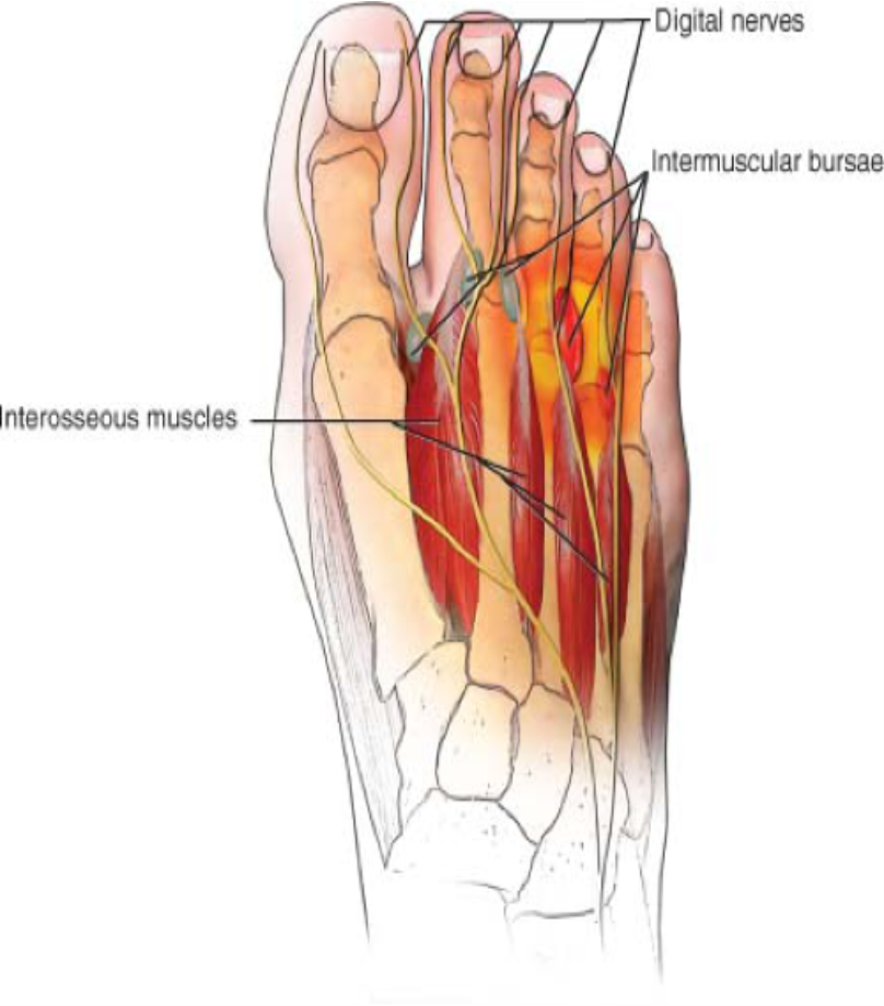 Intermetatarsal Bursitis treatment Ashgrove