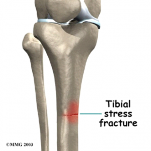 Medial Tibial Stress Fracture podiatrist