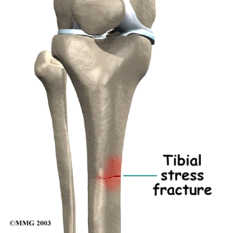 Tibial stress Fracture. Стрессовый перелом берцовая кость. Стрессовый перелом большеберцовой кости. Стрессовый перелом берцовой кости.