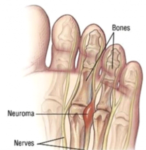 Mortons Neuroma Treatment odiatrist